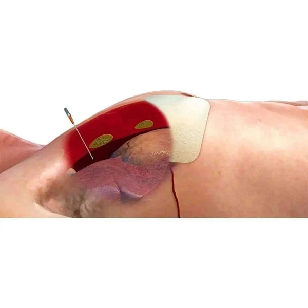 ARS for Needle Decompression - Image 2