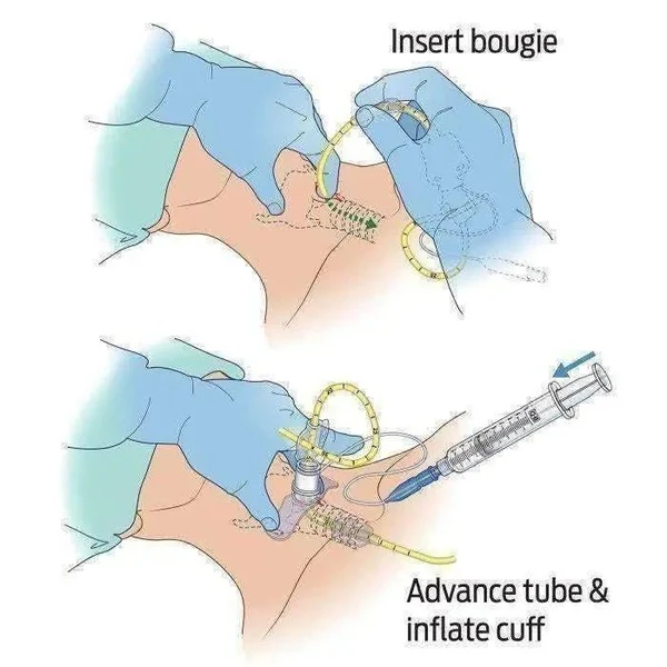 Bougie-Aided Cricothyroidotomy Pack (BAC-Pack™) - Image 7