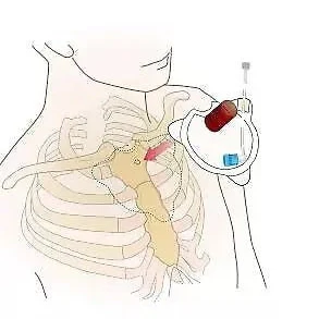 FAST1 Intraosseous Infusion System - Image 4