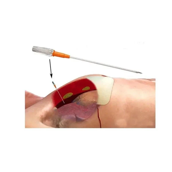 MTI Chest Decompression Needle - Image 3