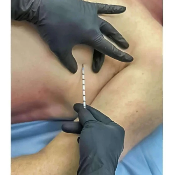 SPEAR - Simplified Pneumothorax Emergency Air Release) Device - Image 3