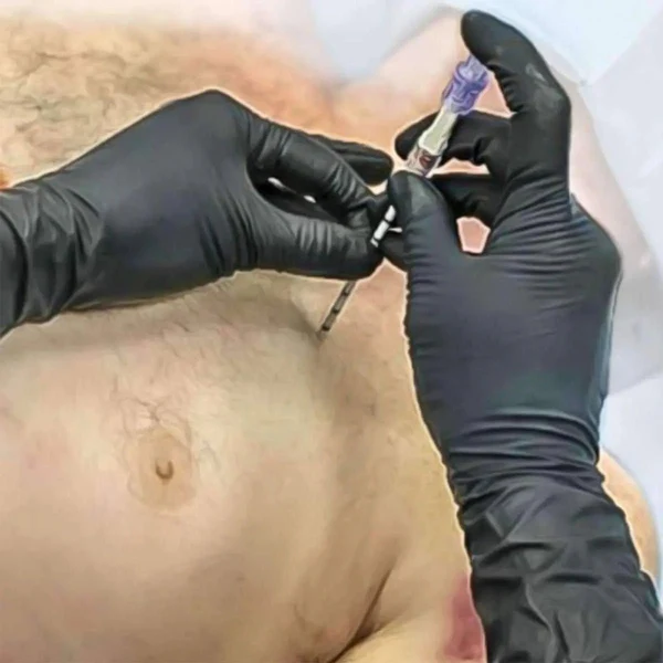 SPEAR - Simplified Pneumothorax Emergency Air Release) Device - Image 5