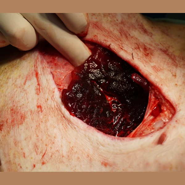 WoundClot® EMS Hemostatic Gauze, Z-Fold — 3" x 39" - Image 3